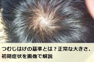 ハゲ治療ゼミ 薄毛 Aga治療 育毛剤の徹底研究サイト