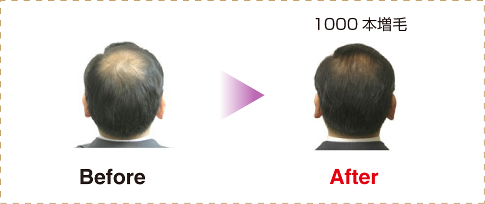 M字ハゲ(生え際前髪の薄毛) 増毛にかかる時間