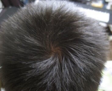 つむじはげの基準とは 正常な大きさ 初期症状を画像で解説 ハゲ治療ゼミ 薄毛 Aga治療 育毛剤の徹底研究サイト