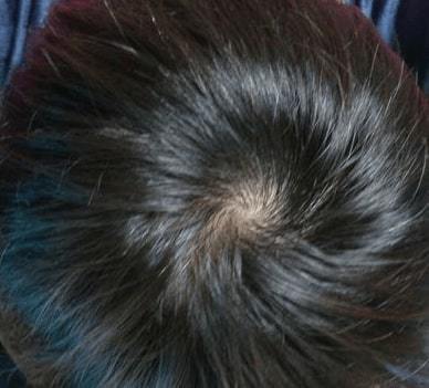 つむじはげの基準とは 正常な大きさ 初期症状を画像で解説 ハゲ治療ゼミ 薄毛 Aga治療 育毛剤の徹底研究サイト