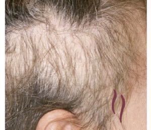 M字ハゲ(生え際前髪の薄毛) 甲状腺ホルモン異常による薄毛