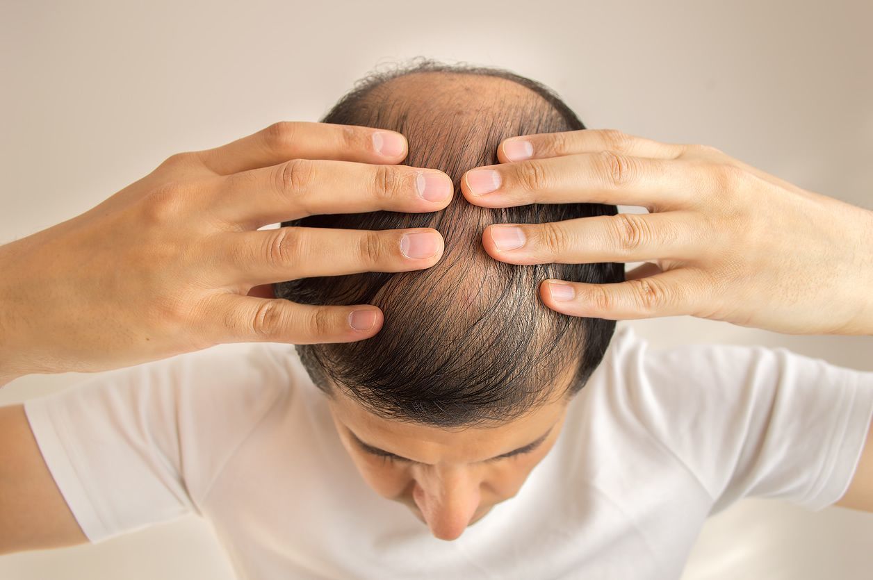 後頭部ハゲでもカッコよく おすすめの髪型8選 ハゲ治療ゼミ 薄毛 Aga治療 育毛剤の徹底研究サイト