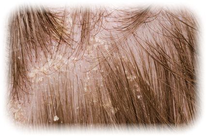 薄毛対策薄毛治療 粃糠（ひこう）性脱毛症