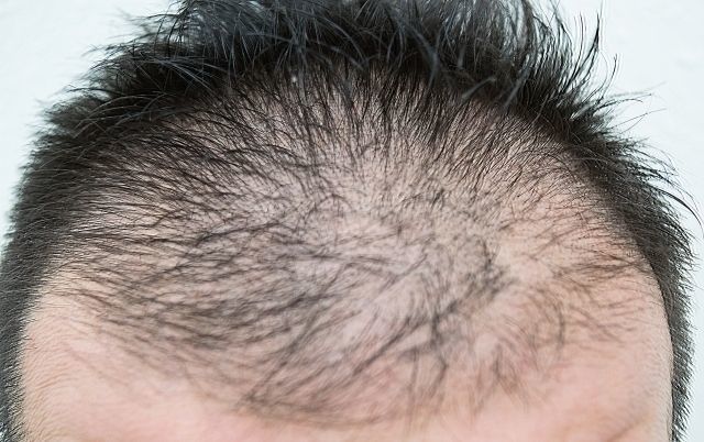 AGA若ハゲの治療 髪の毛の成長スピードも理由のひとつ