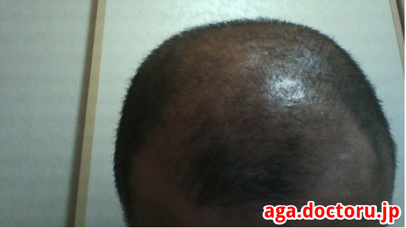 AGA治療の体験談 チャップアップの実際の効果はＭ字部分の新毛