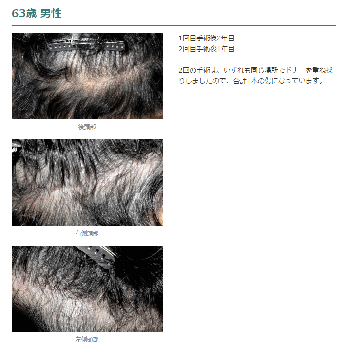 自毛植毛 縫合法の傷（FUT法）