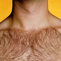ミノキシジル 髭以外の多毛症の事例