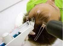 AGA専門クリニック 治療4. 発毛カクテル注射