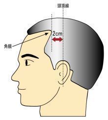 AGA若ハゲの原因 額の生え際から、頭頂線までの距離で判別