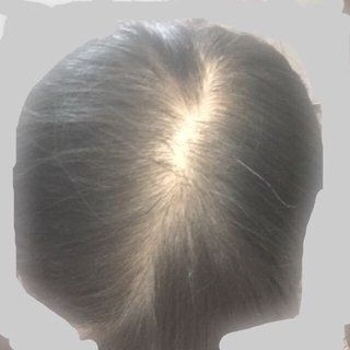 10代女性の薄毛の原因とは 若ハゲに悩む女性の抜け毛対策 治療方法まとめ ハゲ治療ゼミ 薄毛 Aga治療 育毛剤の徹底研究サイト