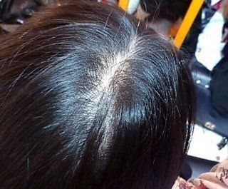 10代女性の薄毛の原因とは 若ハゲに悩む女性の抜け毛対策 治療方法まとめ ハゲ治療ゼミ 薄毛 Aga治療 育毛剤の徹底研究サイト