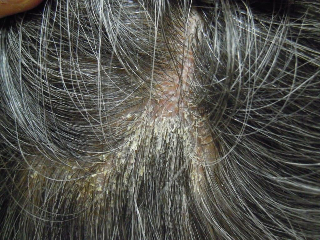 脂漏性脱毛症 脂漏性皮膚炎によって頭皮のかゆみやフケが発生する