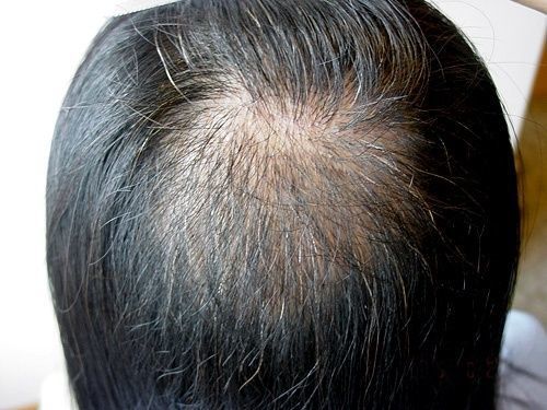 薄毛対策薄毛治療 写真で抜毛症の症状をチェック
