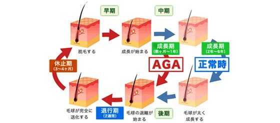 AGA若ハゲの原因 Step2. ヘアサイクルを乱して抜け毛を引き起こす